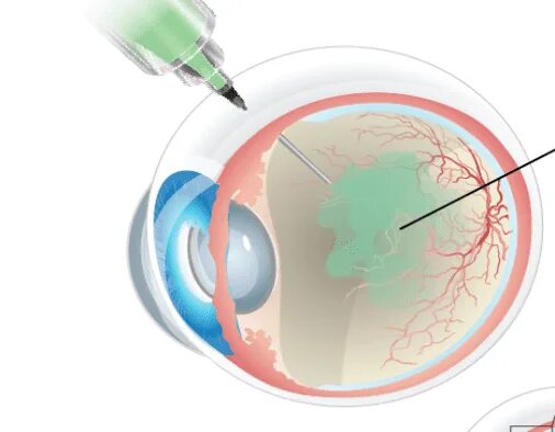 Интравитреальная инъекция. Субконъюнктивальное Введение. Интравитреальное Введение. Субконъюнктивальные инъекции. Внутриглазные инъекции.