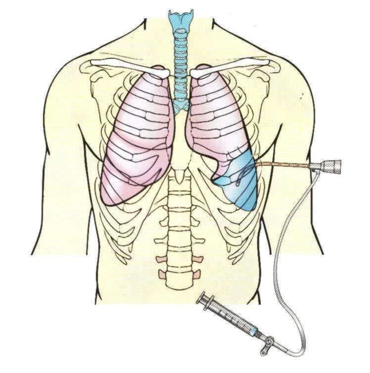 Плевральная пункция торакоцентез. Пневмоторакс дренирование плевральной полости. Пневмоторакс дренирование плевральной.