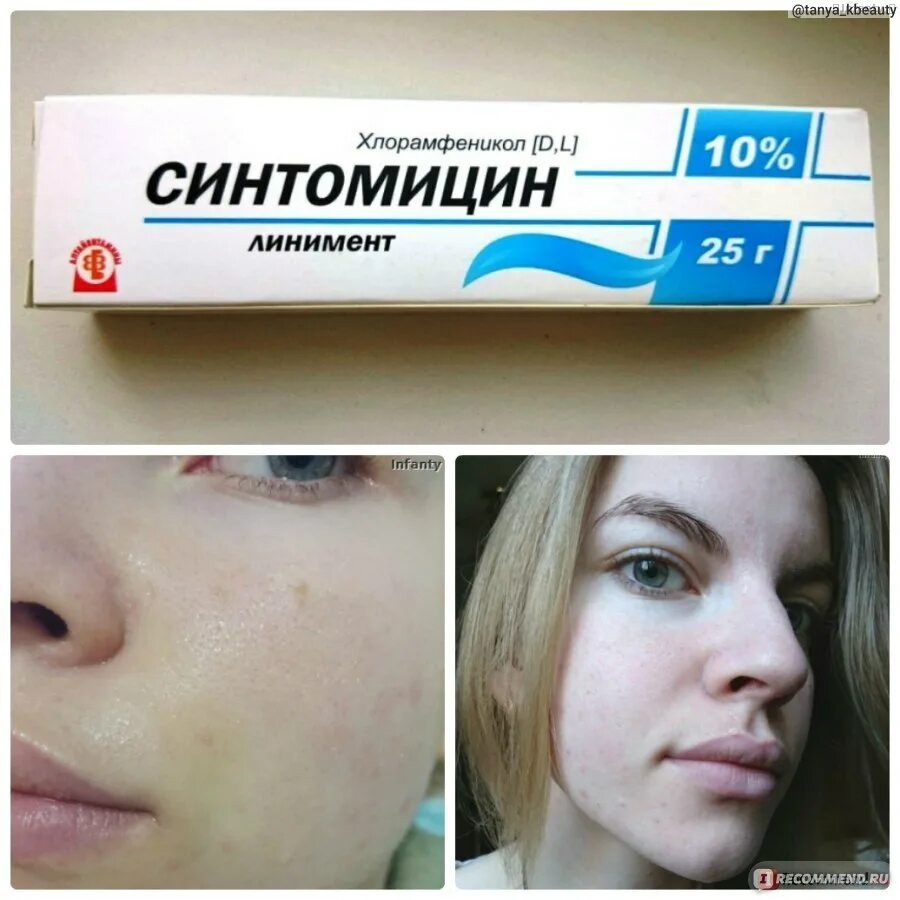 Синтомицин от прыщей. Синтомициновая мазь. синтомицин мазь для лица. крем от прыщей синтомицин.