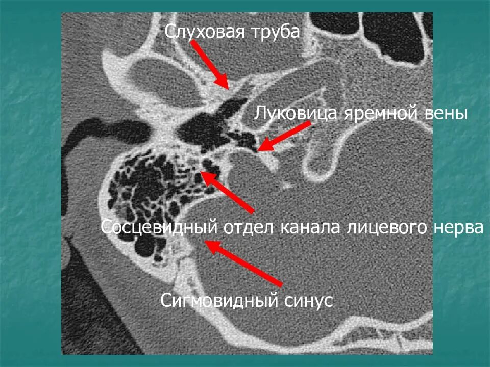 Луковица яремной вены на кт височных костей. Яремная Вена и височная кости на кт. Сосцевидный отросток височной кости кт. Луковица яремной вены на кт.