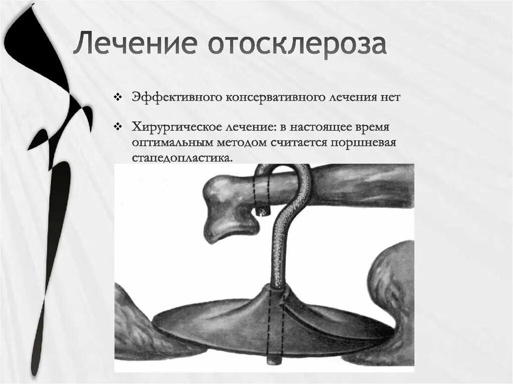 Отосклероз уха операция. Фенестральный отосклероз. Отосклероз стапедопластика. Симптомы при отосклерозе. Поршневая стапедопластика.