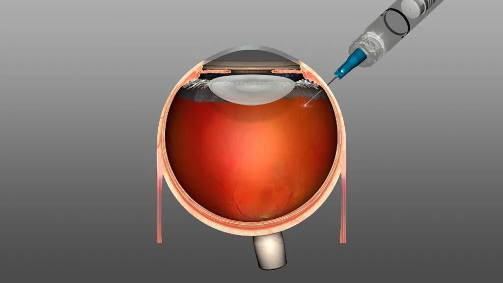 Интравитреальная инъекция. Интравитреальное Введение ингибиторов ангиогенеза. Интравитреальные инъекции VEGF. Промывание передней камеры глаза. Интравитреальные инъекции анти-VEGF препаратов.