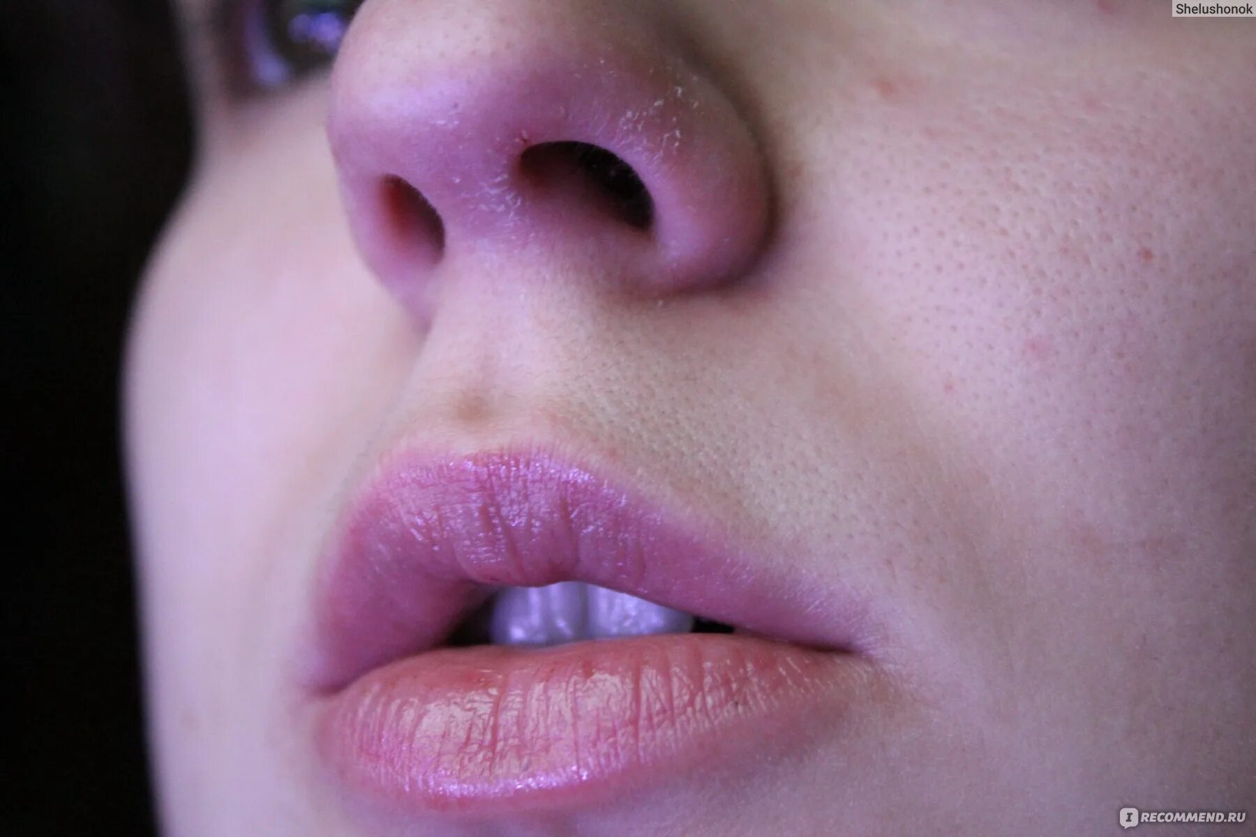 Как лечить губы от сухости и трещин. Как вылечить губы от трещин. Как лечить губы т рот после химии. Как заживить губу от трещин. Губы трещины сухость