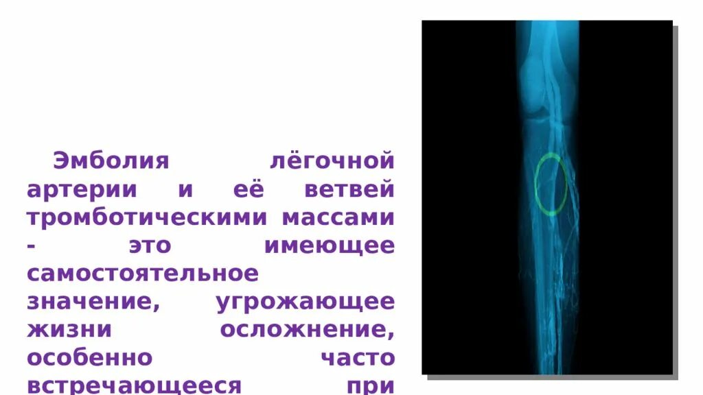 Тромбоэмболия легочной артерии код по мкб. Эмболия легочной артерии. Тромбоэмболия артерии. Тромботические массы в легочных артериях. Септическая эмболия легочных артерий.