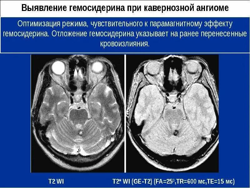 Кавернозная ангиома прогноз. Гемангиома головного мозга кт. Рацемозные гемангиома. Кавернозная ангиома мозжечка. Гемангиома головного мозга кт.