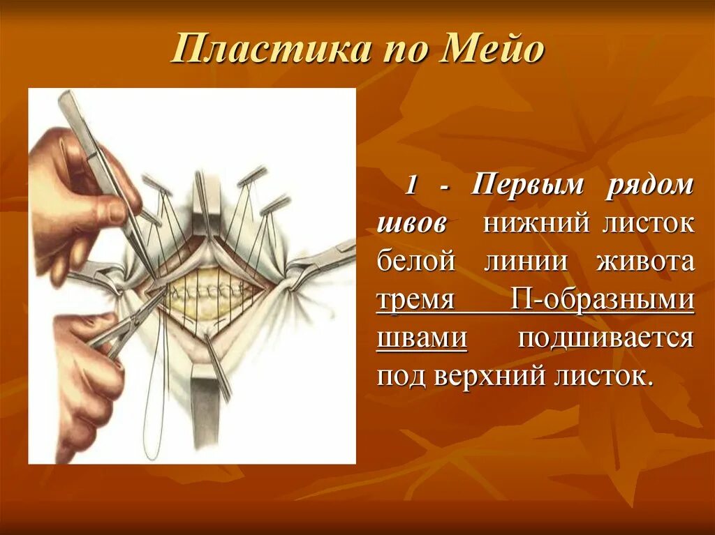 Грыжесечение sublay пластика. Пластика пупочной грыжи по мейо. Ромбовидный лоскут по лимбергу. Пластика по другому. Пластика кожным лоскутом на питающей ножке.