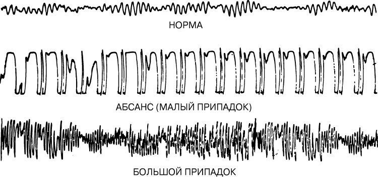 Ээг при эпилепсии. Ээг здорового человека и эпилептика. патологические ритмы ээг при эпилепсии. ээг при абсансной эпилепсии. как выглядит эпилепсия на ээг.