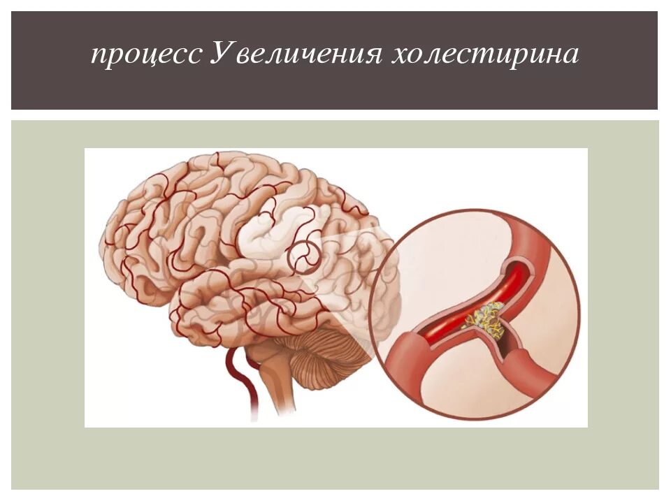 Атеросклероз сосудов голов мозга. Атеросклероз сосудов голов мозга