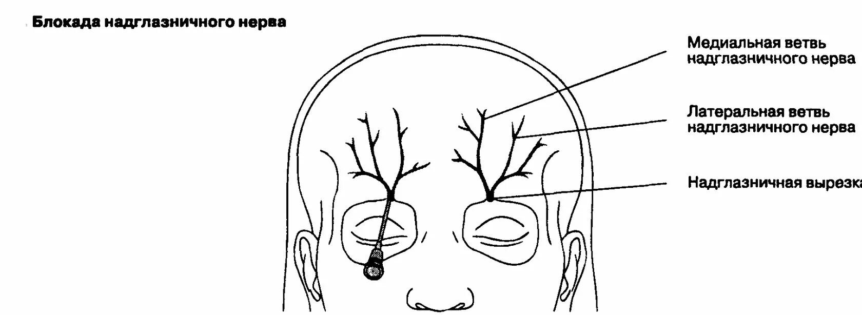 Нервная блокада. Блокада III ветви тройничного нерва. Проекция надглазничного нерва. Схема блокады ветвей тройничного нерва. Блокада ветвей тройничного нерва топографическая анатомия.