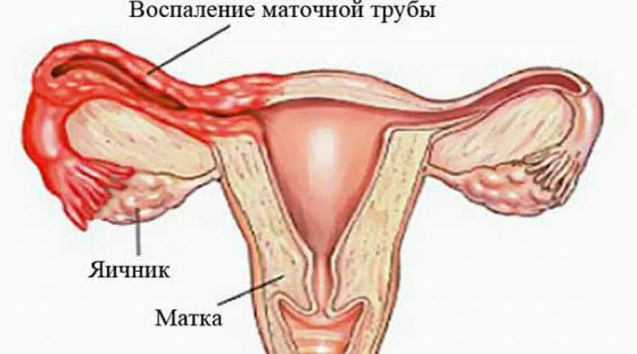 Внутреннее воспаление матки. Сальпингоофорит (аднексит). Воспаление маточных труб. Воспаление придатков оофорит.