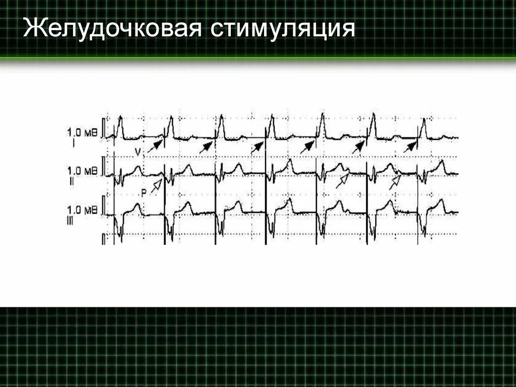 Двухкамерная стимуляция. Удовлетворение женщины. Двухкамерная стимуляция на фоне ав блокады 2 -3 ст. Просто стимуляция. Смт увч магнитотерапия.