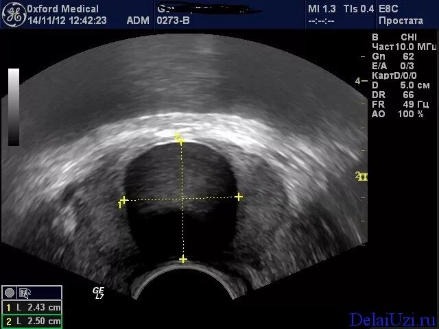 Дгпж узи. УЗИ снимки аденомы простаты у мужчин. УЗИ трузи предстательной железы. УЗИ простаты трансабдоминально. Гиперплазия предстательной железы УЗИ.