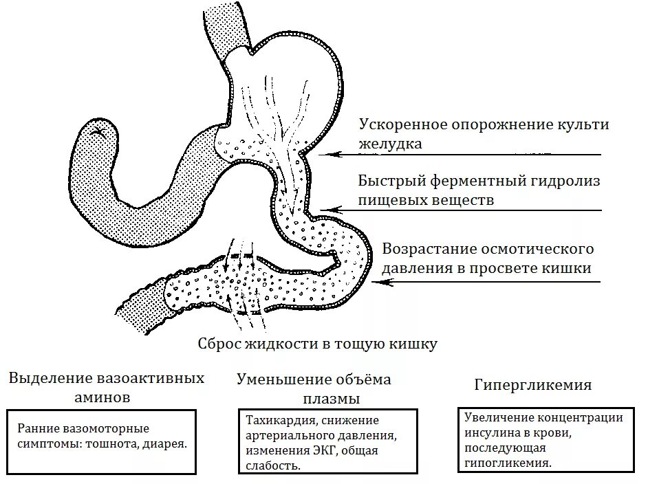 Демпинг синдром это. Демпинг синдром этиопатогенез. ранний демпинг синдром механизм. демпинг синдром после резекции желудка. демпинг синдром этиология.