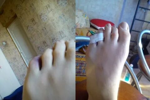 Как заживает перелом пальца ноги