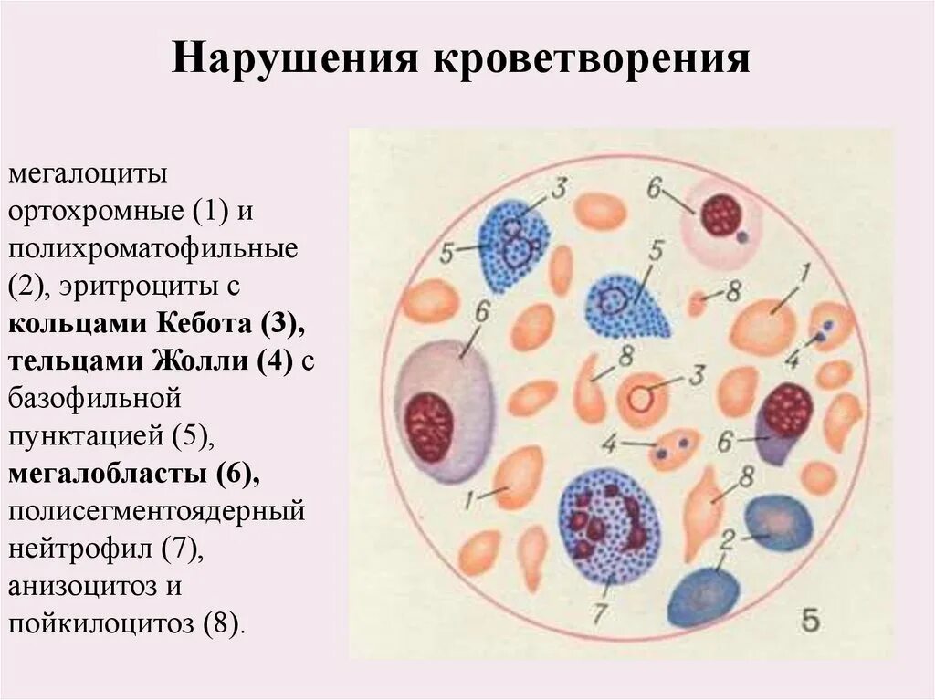 Пойкилоцитоз анемия. Пойкилоцитоз эритроцитов. Микроцитоз макроцитоз анизоцитоз пойкилоцитоз. Тельца Жолли и Кебота. Анизоцитоз пойкилоцитоз тельца Жолли кольца Кебота.