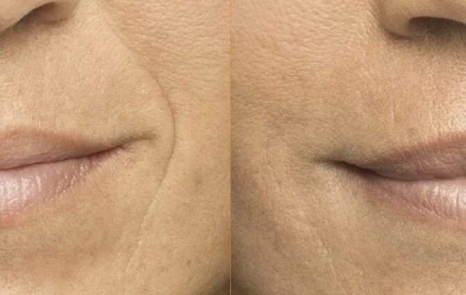 бланширование филлером