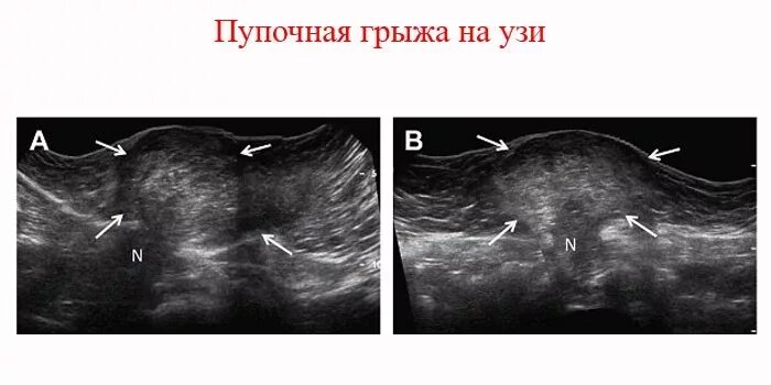 Фото узи пупочной грыжи