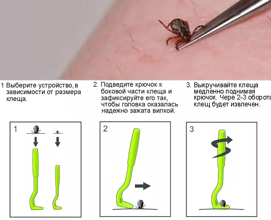 Способ достать. Устройство для снятия клещей с собаки. приспособление вытащить клеща. крючок для извлечения клещей. как вытащить клеща специальным пинцетом.