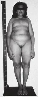Slideshow nude downs syndrome.