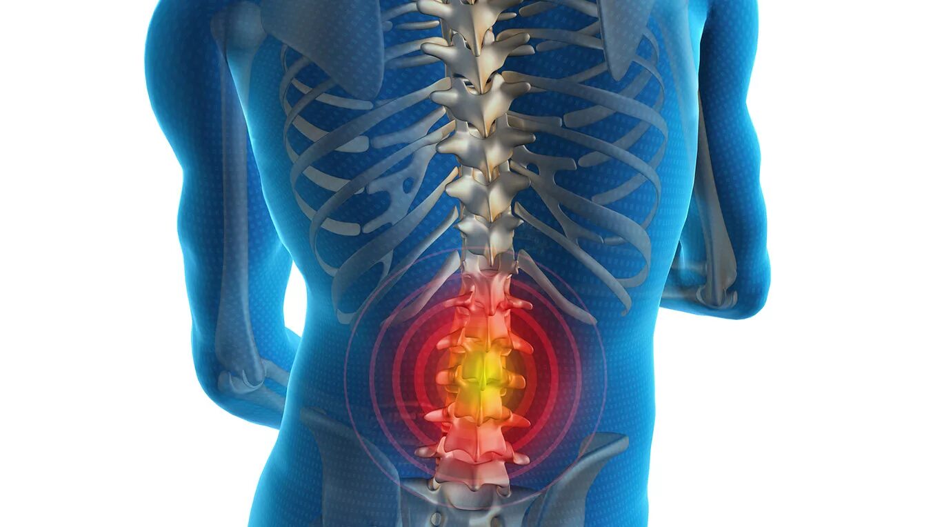 Камни в пояснице. Люмбаго в пояснице. Люмбаго поясничного отдела позвоночника.