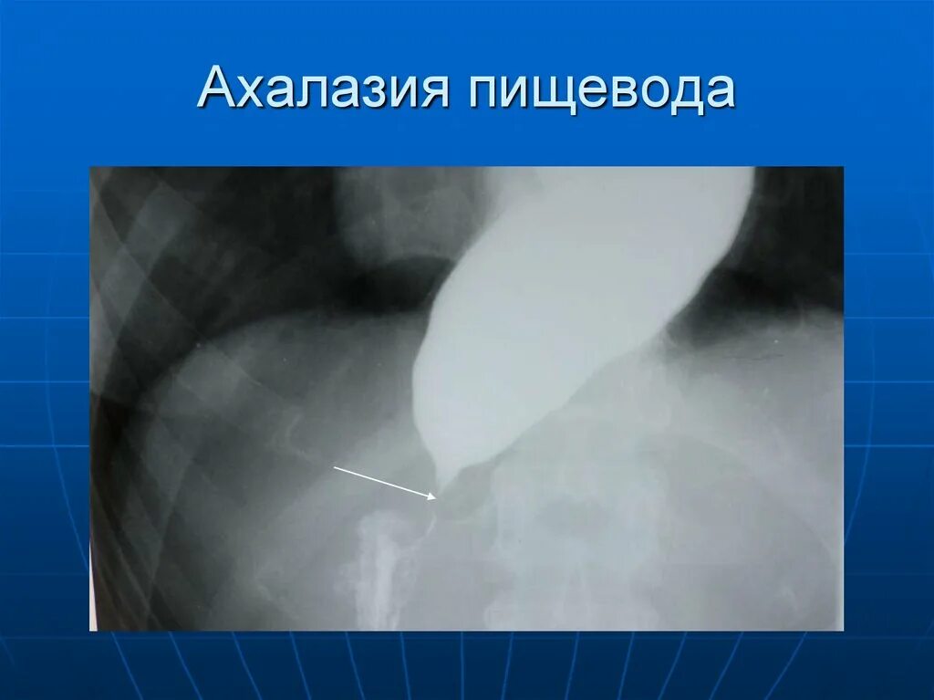 Ахалазия пищевода 3 степени рентген. Ахалазия кардии пищевода. Ахалазия желудка рентген. Недостаточность физиологической кардии что это такое. Симптомы ахалазии кардии пищевода.