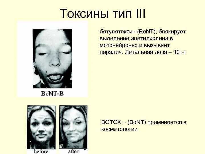 Ботулотоксин вызывает. Ботулотоксин яд.