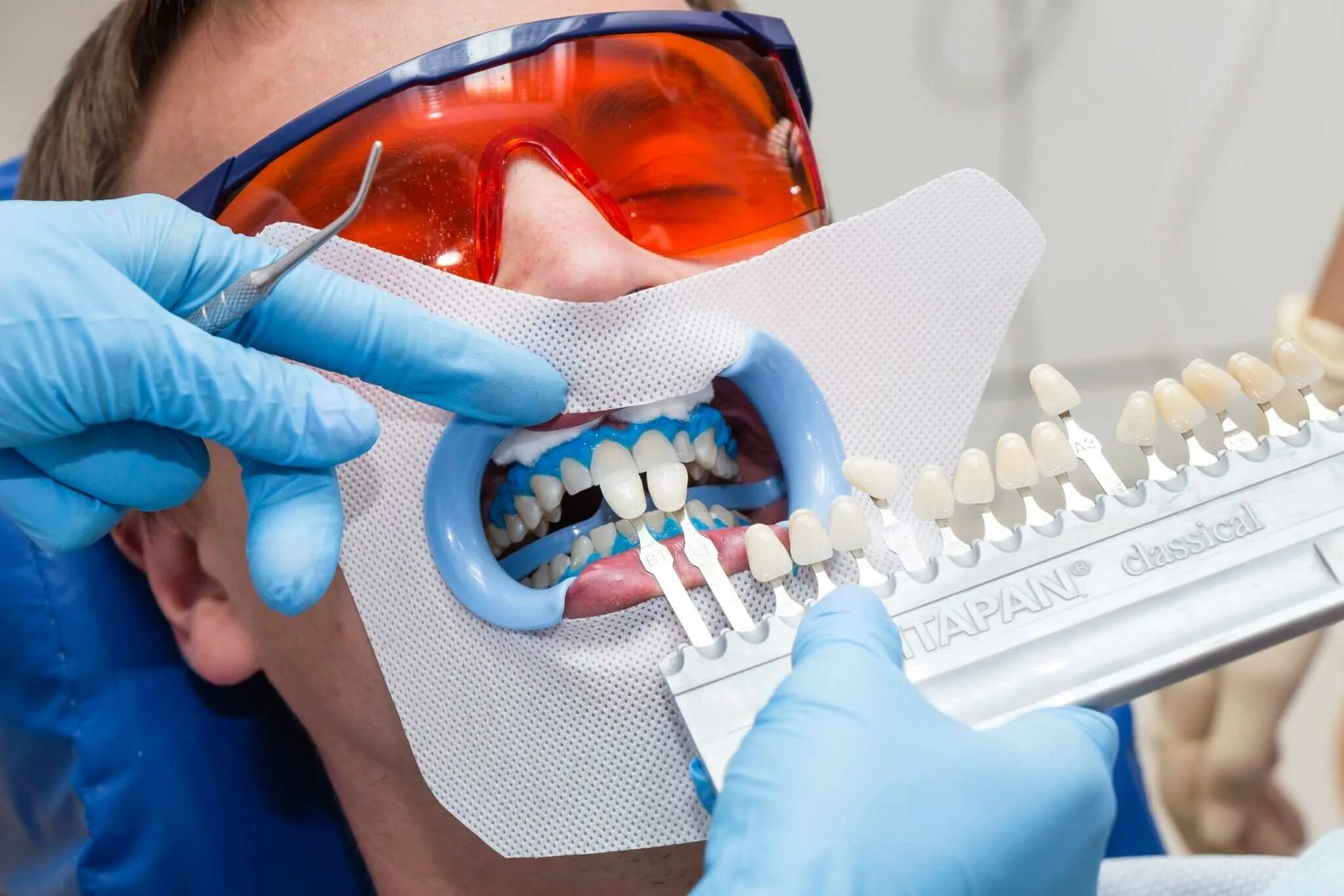 Отбеливание. Зубы стоматология. Профессиональное отбеливание зубов. Стоматология отбеливание.