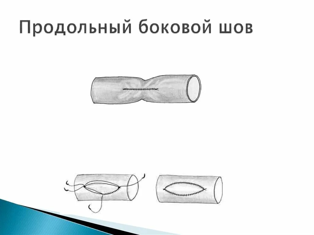 Продольный и поперечный шов. Однорядная система перевязки. Труба с двумя продольными сварными швами. Продольный шов. Боковой сосудистый шов.
