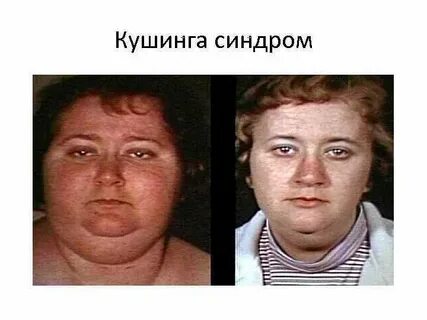 Гипотериоз после лечения