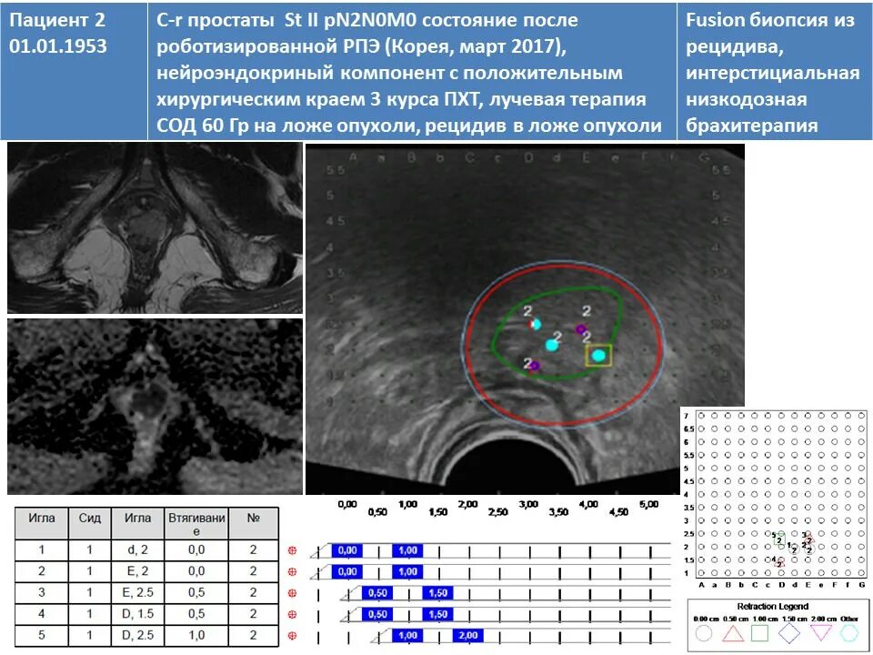 Fusion биопсия предстательной железы. Фьюжн биопсия предстательной железы мрт. Мрт после брахитерапии простаты. Протокол биопсии предстательной железы.