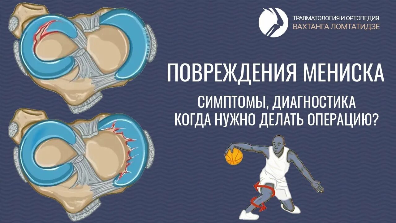 Мкб 10 мениска. Травматология и ортопедия спортивная травма. лечение травм менисков. повреждение мениска мкб 10.