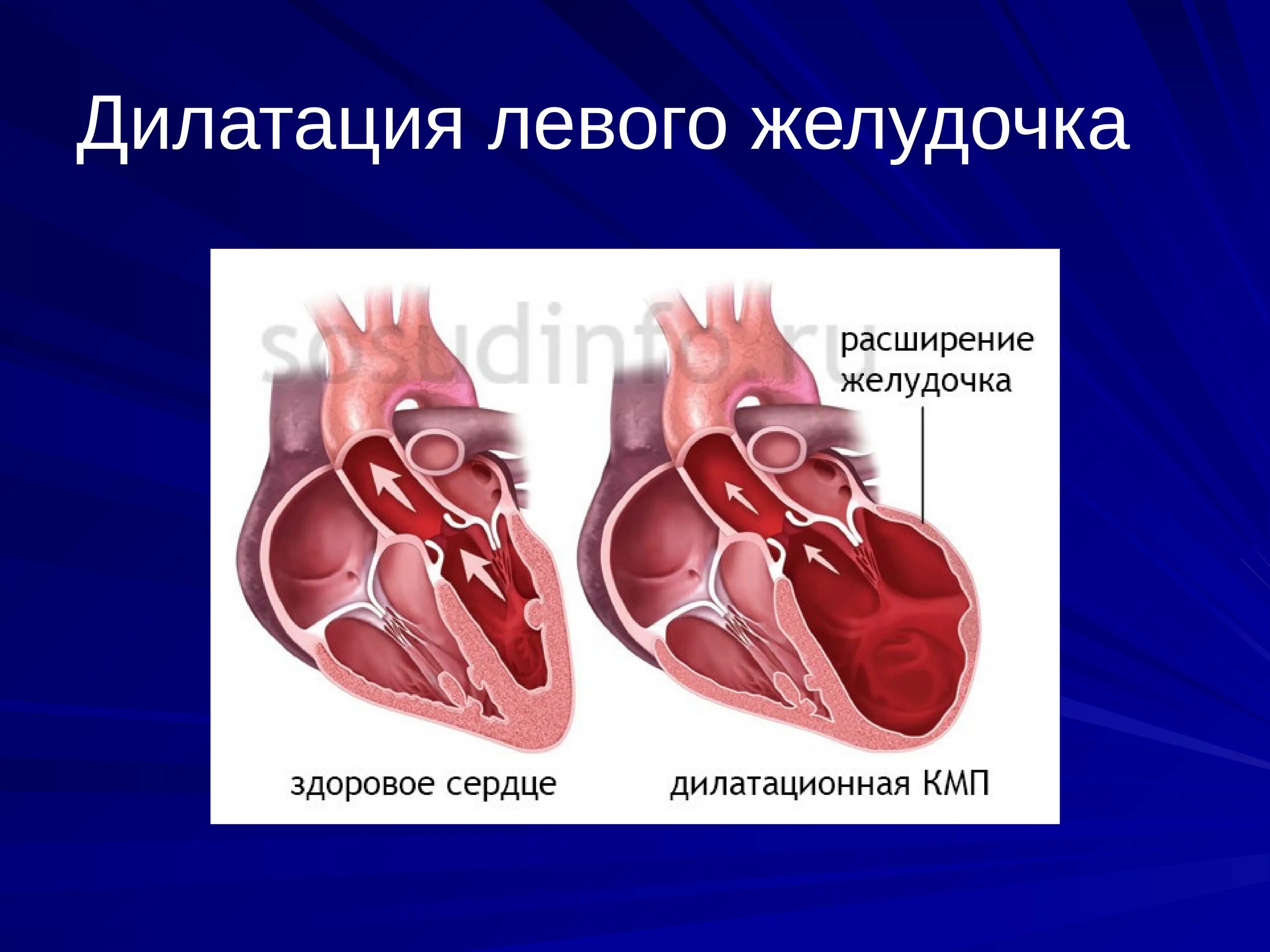 Дилатация левого желудочка что это