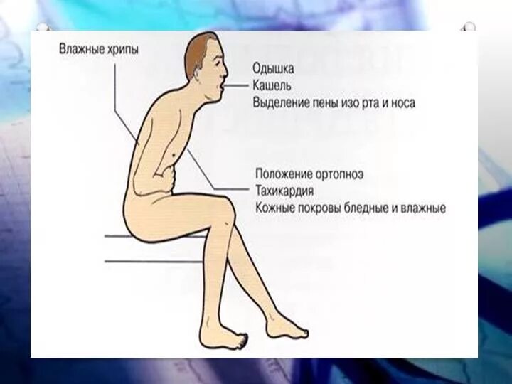 Положение больного при бронхиальной астме. Положение при ортопноэ. ортопноэ положение больного. вынужденное положение ортопноэ. вынужденное положение при хронической сердечной недостаточности.