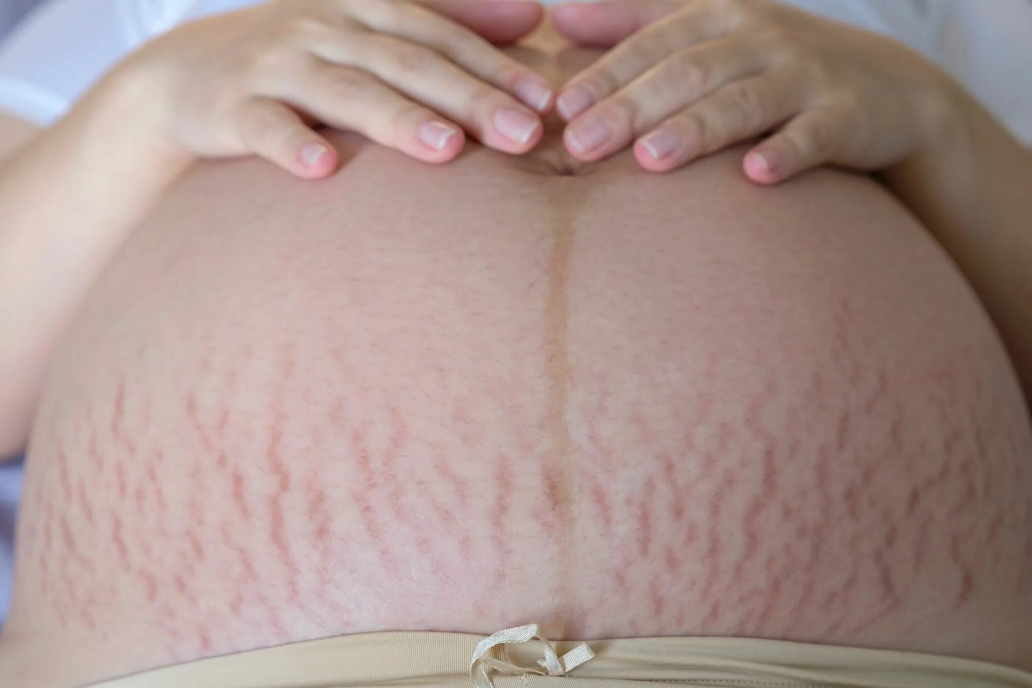 Послеродовые растяжки на животе. Беременный живот с растяжками. Растяжки при беременности. Живот беременной с растяжками. Растяжки у беременных.