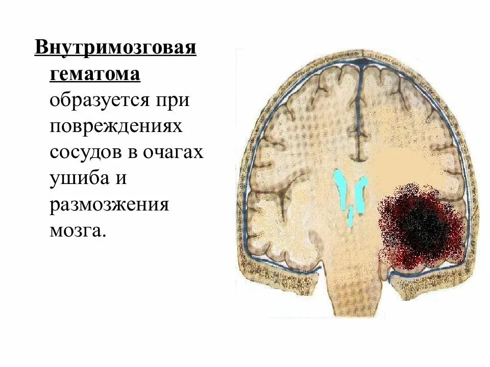 Кровоизлияние в желудочки. Гематома в головном мозге. Внутримозговая гематома. Локализации внутримозговых гематом. Внутримозговая гематома мозга.