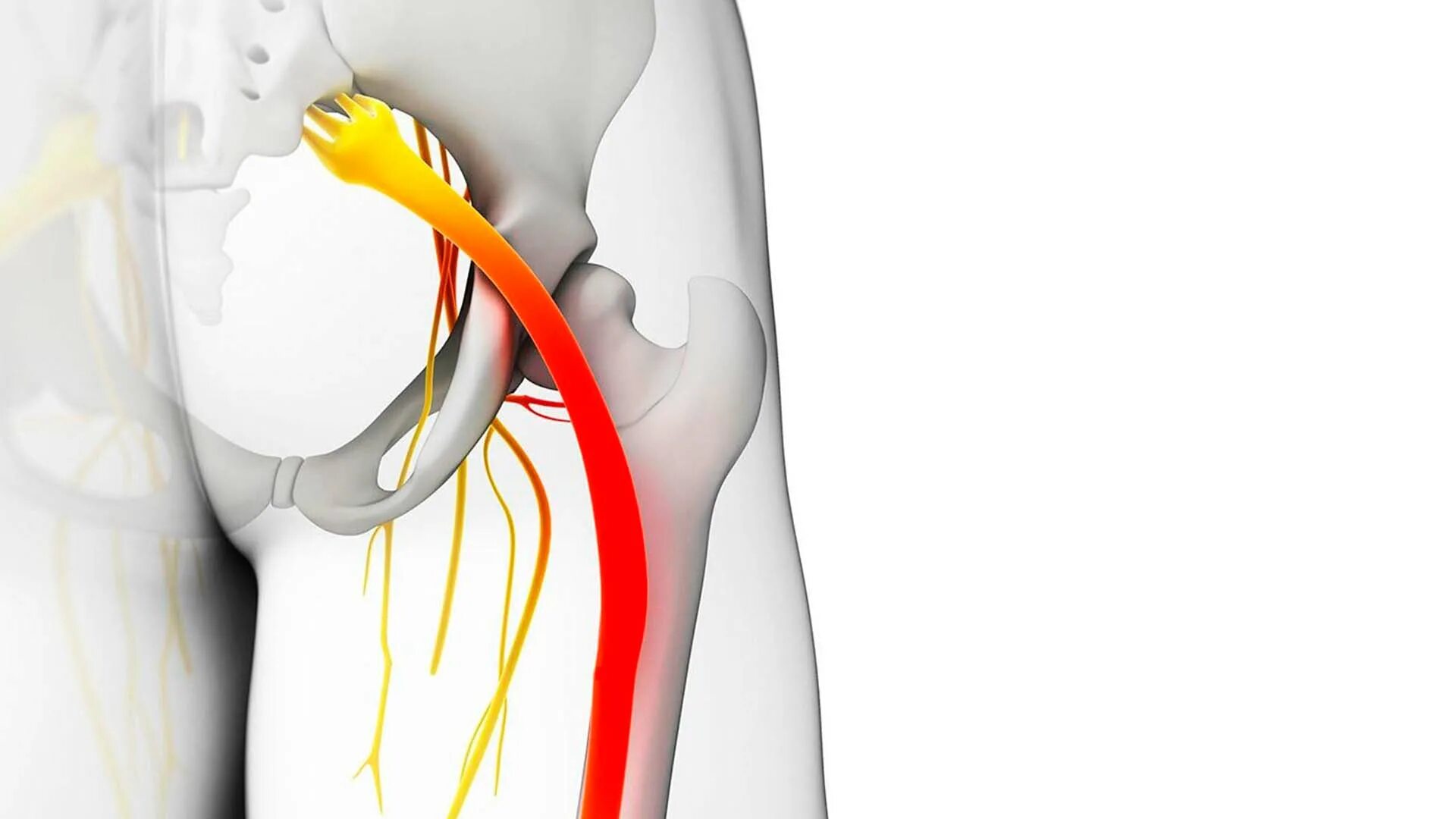 Ишиас воспаление седалищного. Ишиас седалищного нерва. Неврит седалищного нерва. Воспаление седалищного нерва. Воспаление седалищного нерва симптомы у мужчин