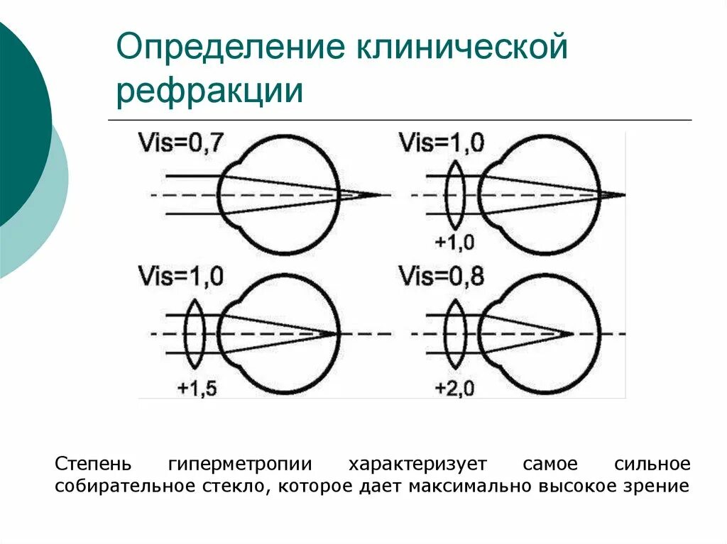 Рефракция. Понятие рефракции. Рефракция хрусталика глаза. Аномалии рефракции глаза физиология. Рефракция это в офтальмологии.