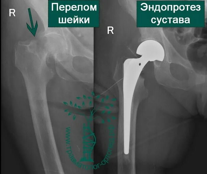 Перелом шейки бедра операция эндопротез. Перелом шейки тазобедренного сустава. Металлоостеосинтез шейки бедра. Осколочный перелом шейки бедра. Перелом шейки бедра лечение операции