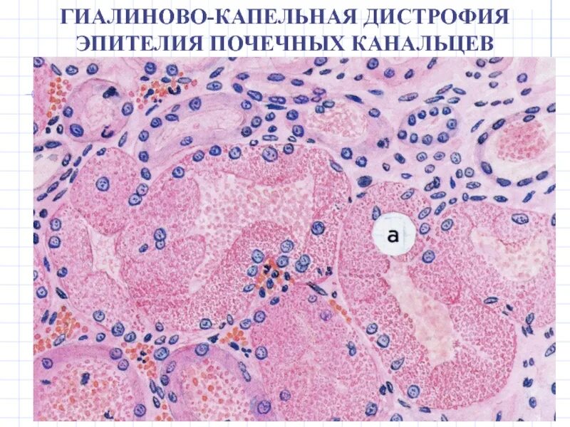 Гидропическая дистрофия гепатоцитов гистология. Дистрофия эпителия канальцев почек. Зернистая дистрофия эпителия почечных канальцев. Гидропическая дистрофия эпителия почечных канальцев. Гидропическая дистрофия почки.