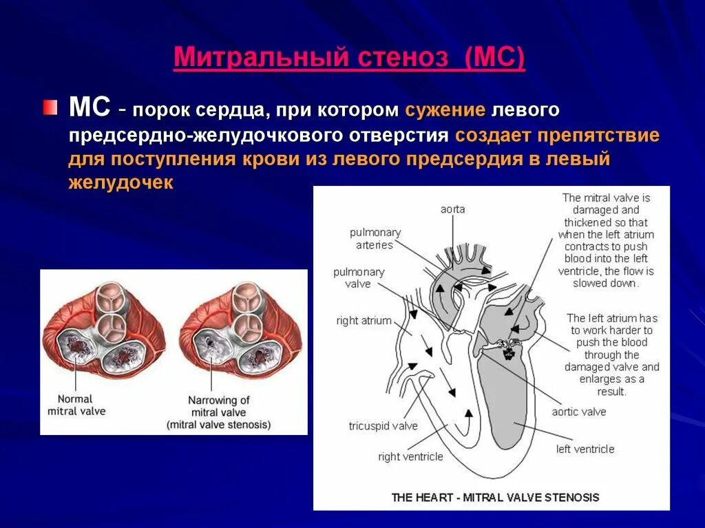 Пороки сердца митральный стеноз. Стеноз левого предсердно-желудочкового отверстия. Левое предсердно-желудочковое отверстие. Сужение митрального отверстия. Клапан правого предсердно желудочкового отверстия