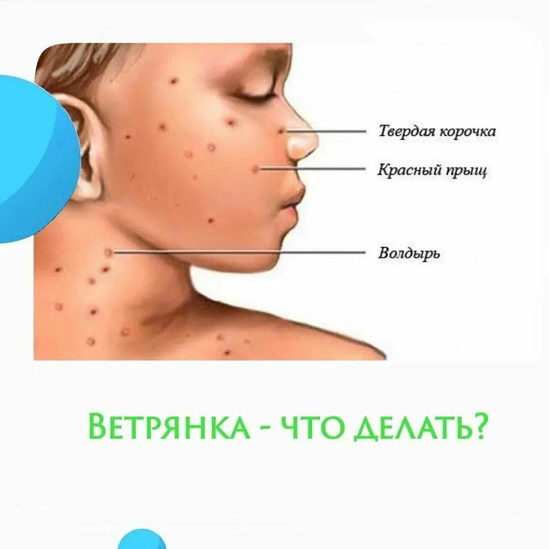 Особенности ветрянки у детей раннего возраста - стоит ли переболеть или сделать 
