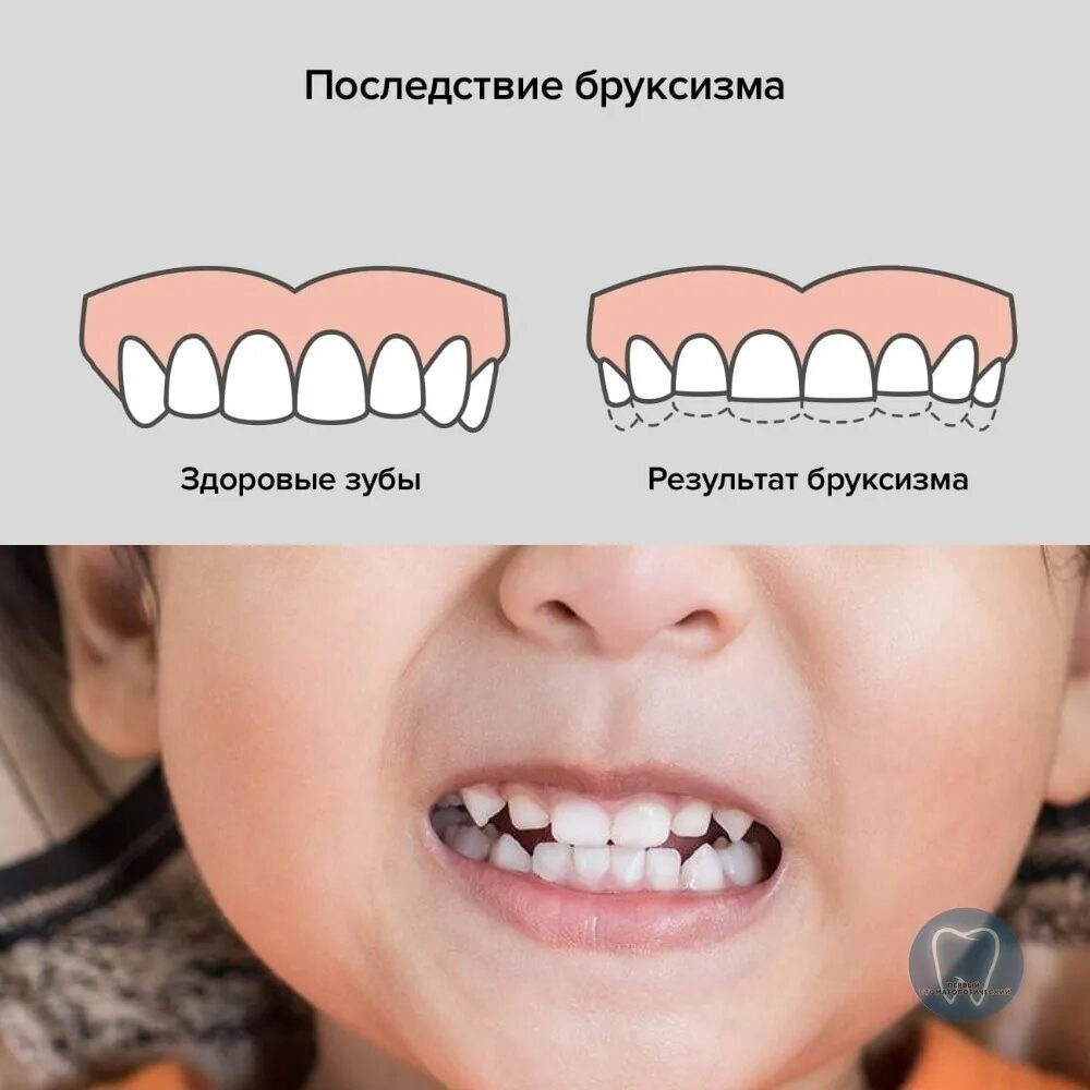 Зубы стучат что значит. Бруксизм скрежетание зубами.