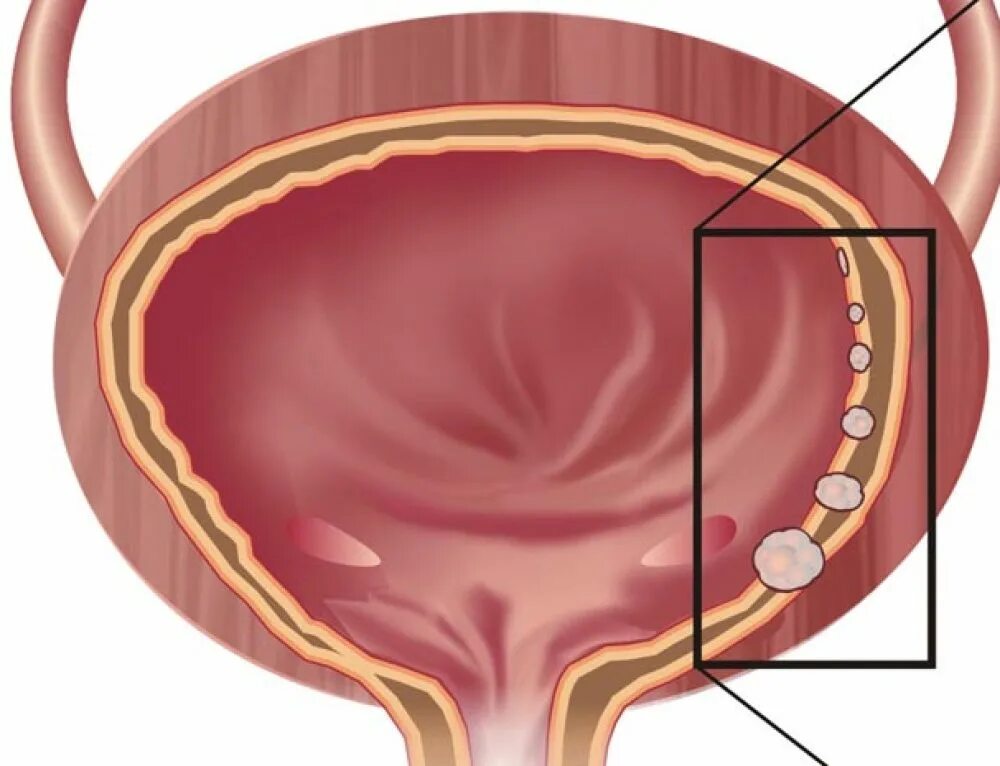 Лечение рака мочевого пузыря у мужчин. Мочевой пузырь сбоку. Двухкамерный мочевой пузырь. Спастический мочевой пузырь. Мочевой пузырь вид сбоку.