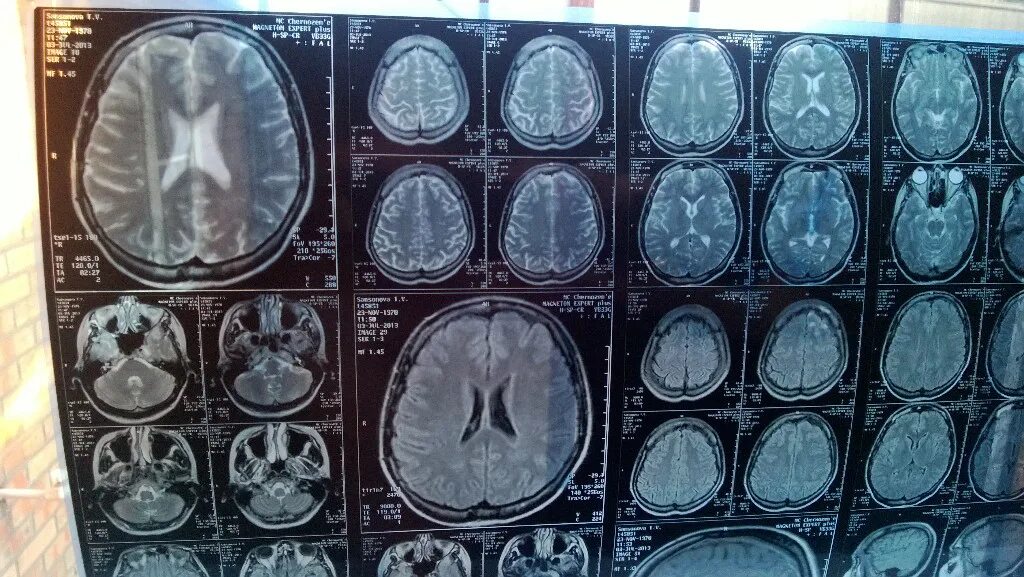 Мрт мозга ульяновске цены. Ликворография головного мозга магнитно-резонансная. Снимки мрт головного мозга. Мрт снимок. Мрт головы.