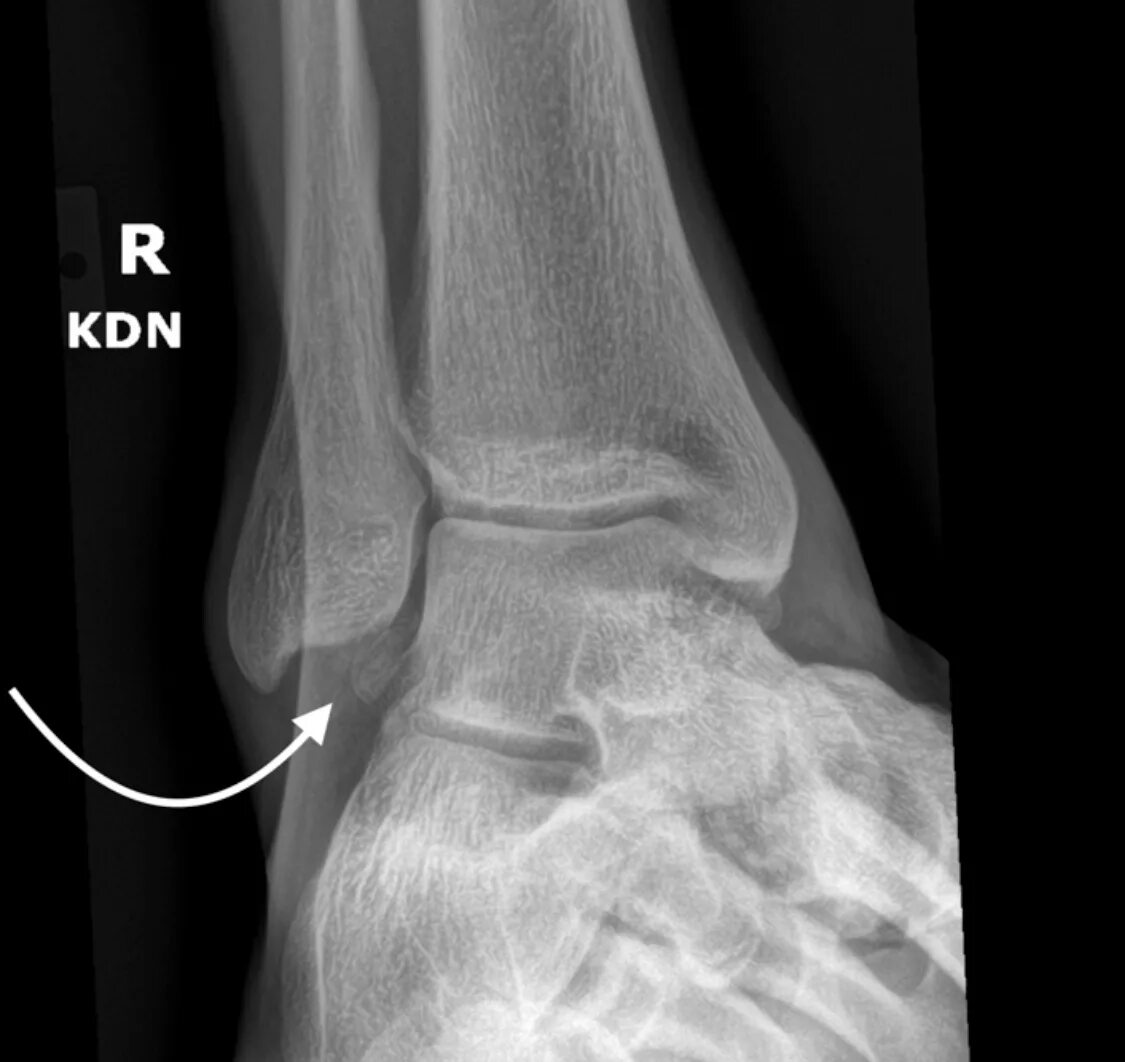 Вывих голеностопного сустава рентген. Перелом латеральной лодыжки рентген. Голеностоп рентген анатомия.