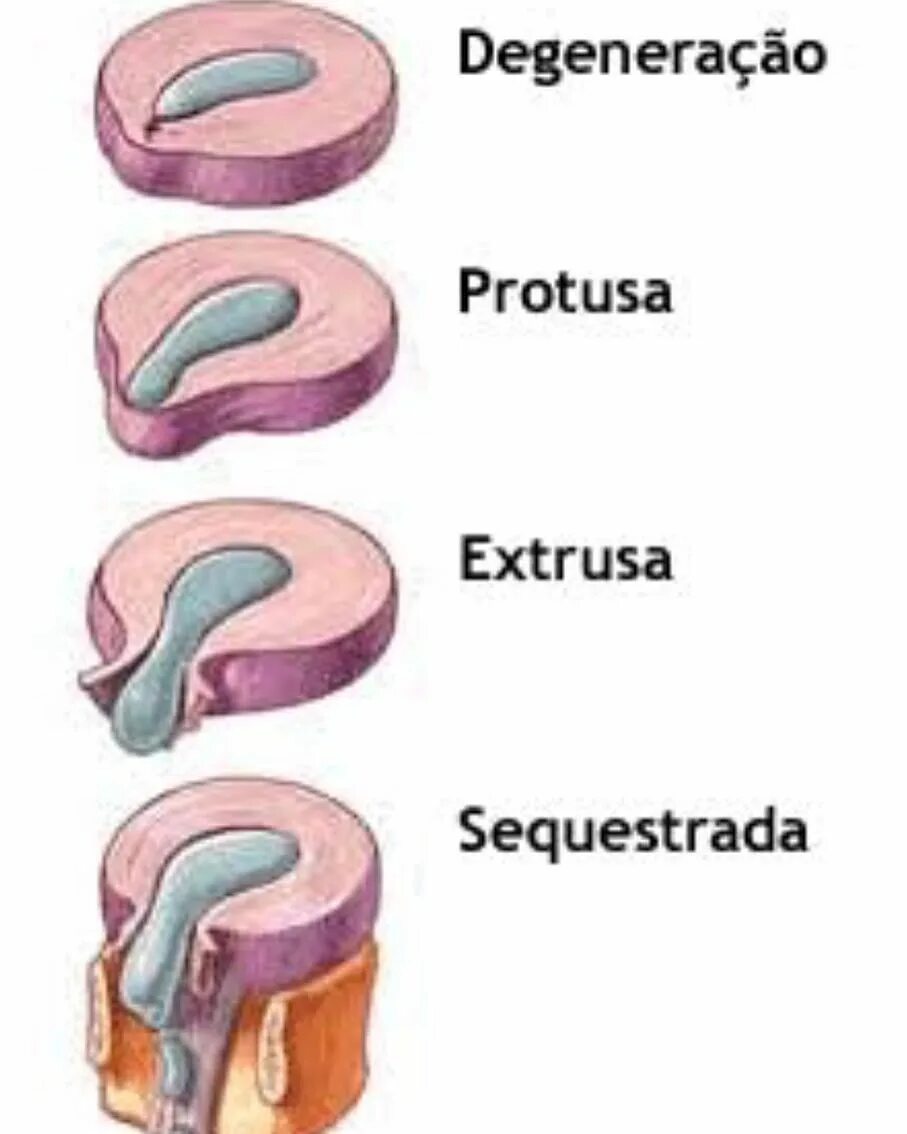 Протру́зия межпозвонкового диска. Межпозвоночный диск протрузия грыжа. Протрузия грыжа межпозвонковых дисков. Экструзия с4-с5 диска.