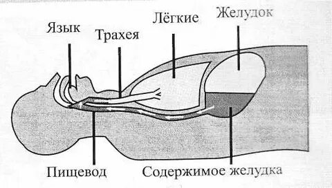 Аспирация содержимого