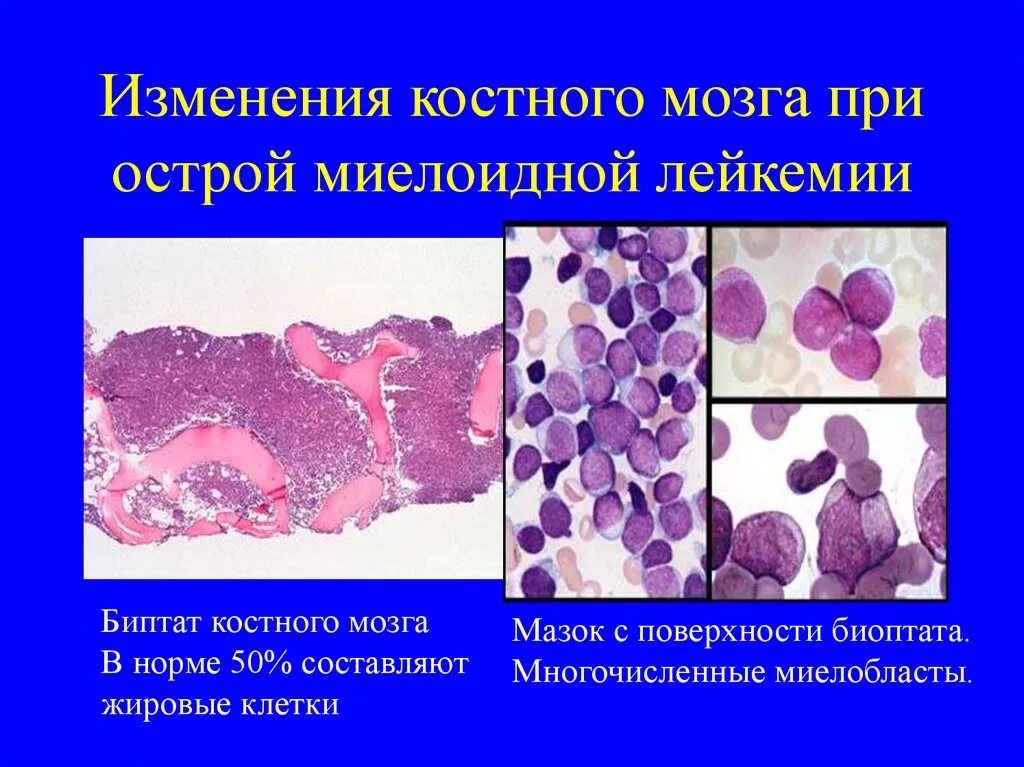 Костный мозг при остром лейкозе макропрепарат. Хронический миелолейкоз костный мозг макропрепарат. Острый миелобластный лейкоз картина костного мозга. Острый миелобластный лейкоз гистология.