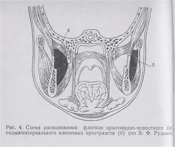 Абсцесс желобка. Абсцессы и флегмоны крыловидно-челюстного пространства. абсцесс крыловидно-нижнечелюстного пространства. флегмона крыловидно-нижнечелюстного пространства. абсцесс и флегмона крыловидно-нижнечелюстного пространства.