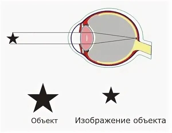 Ночные линзы при миопии
